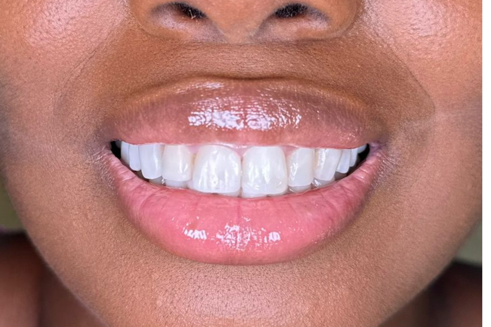 After Composite Veneer Treatment